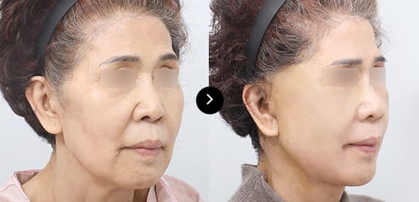 フルSMAS挙上 image 1