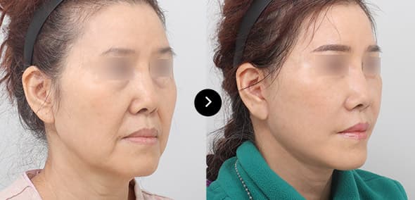 フルSMAS挙上 image 4