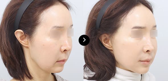 フルSMAS挙上 image 5