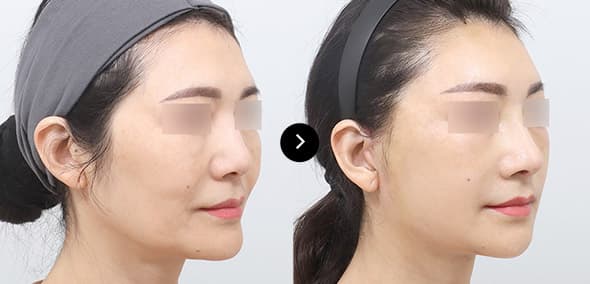 セミフル挙上 image 4