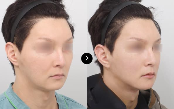 ミニ挙上 image 1