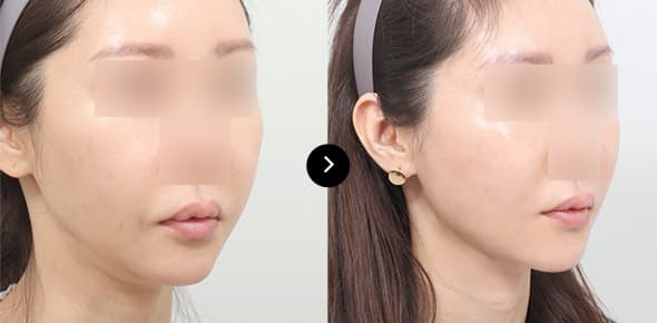 二重顎バンド糸リフト image 4