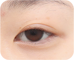 眼瞼下垂がある場合