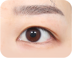 眼瞼下垂がある場合