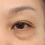 上眼瞼リフト