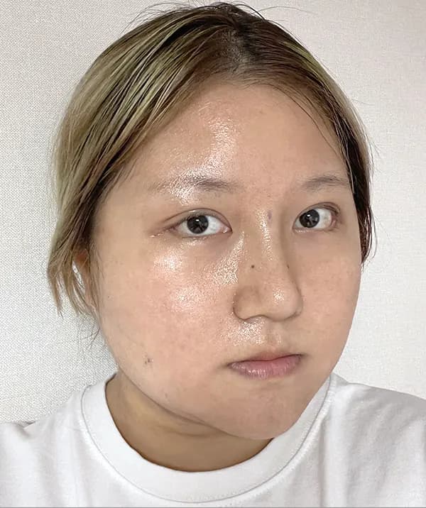 手術後7日目