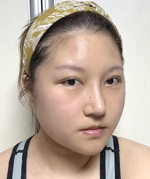 手術後14日目