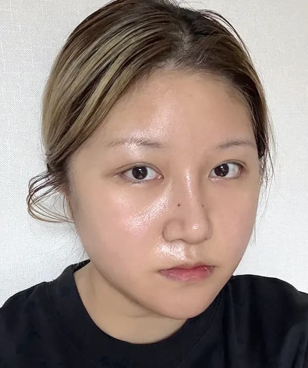 手術後21日目