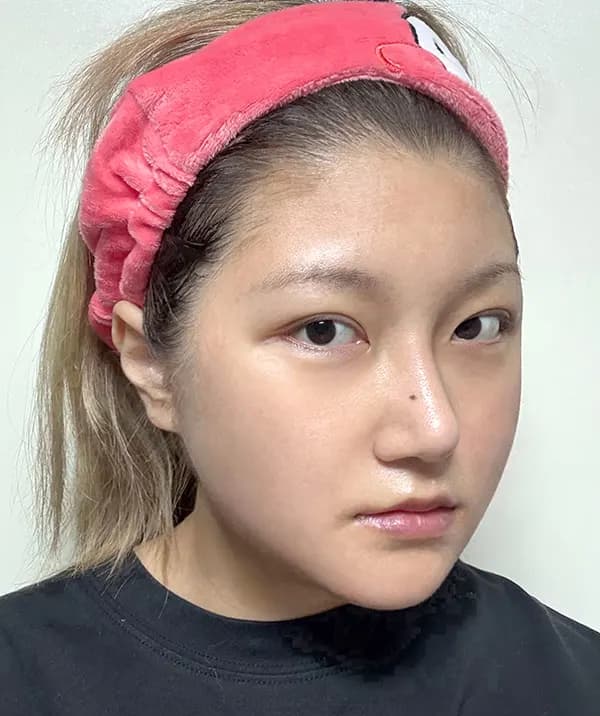 手術後30日目
