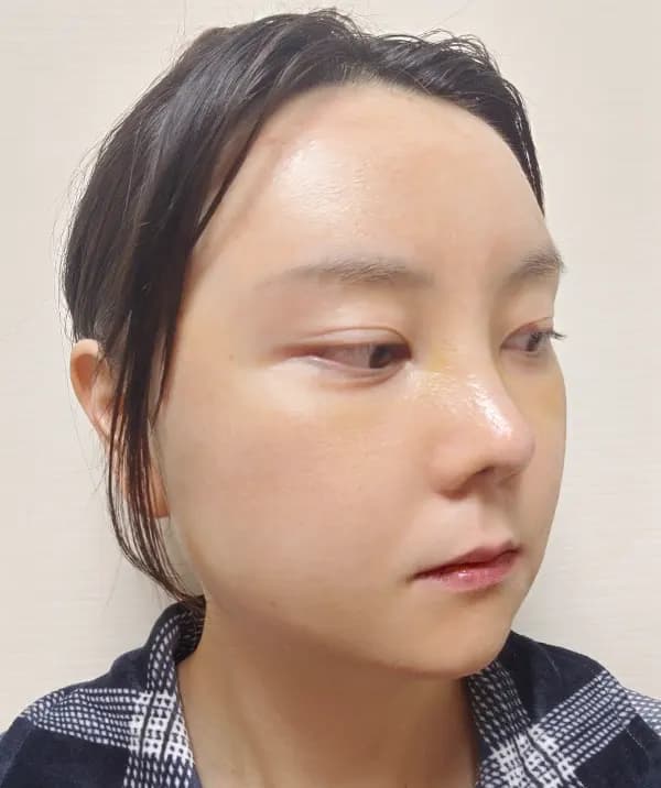 手術後7日目