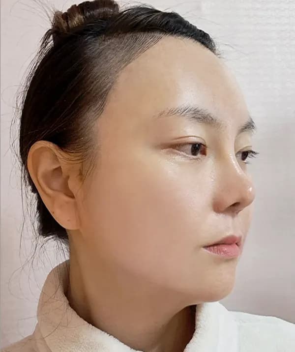 手術後30日目