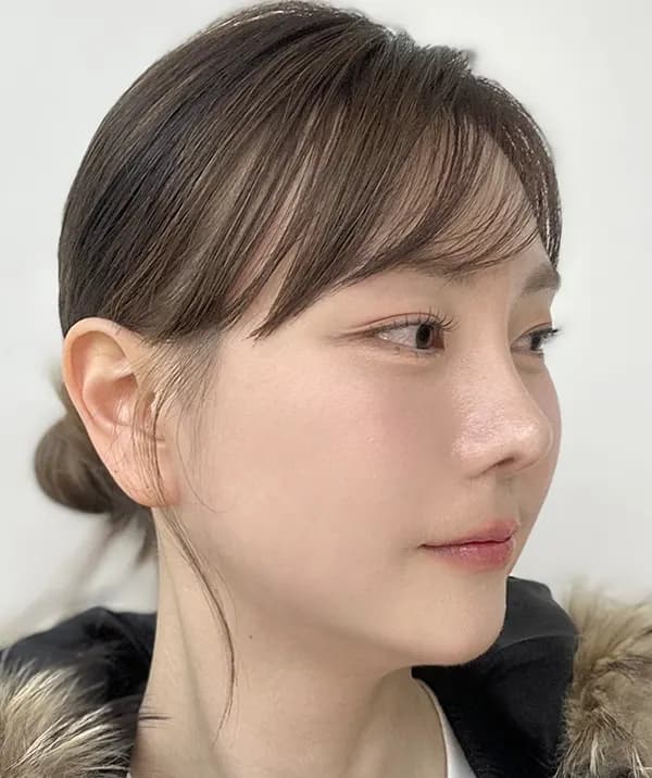 手術後75日目