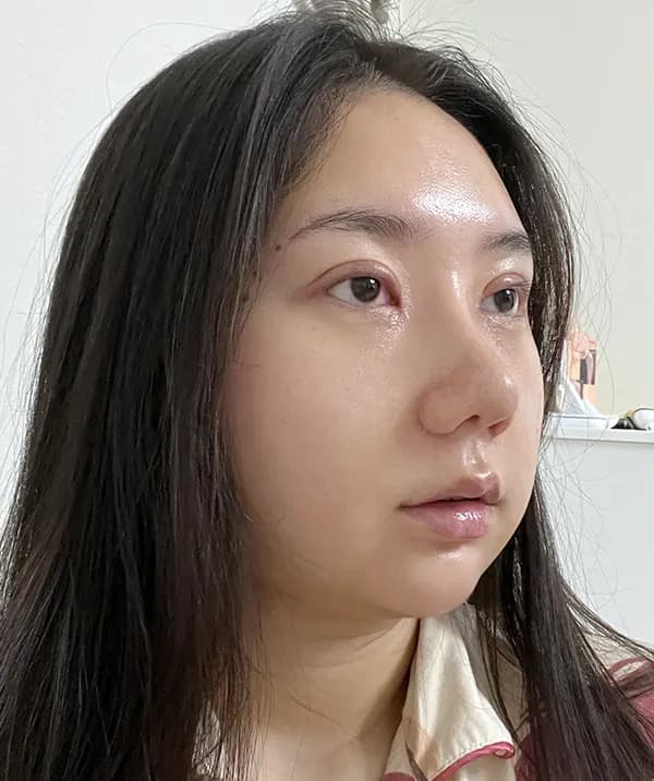 手術後14日目