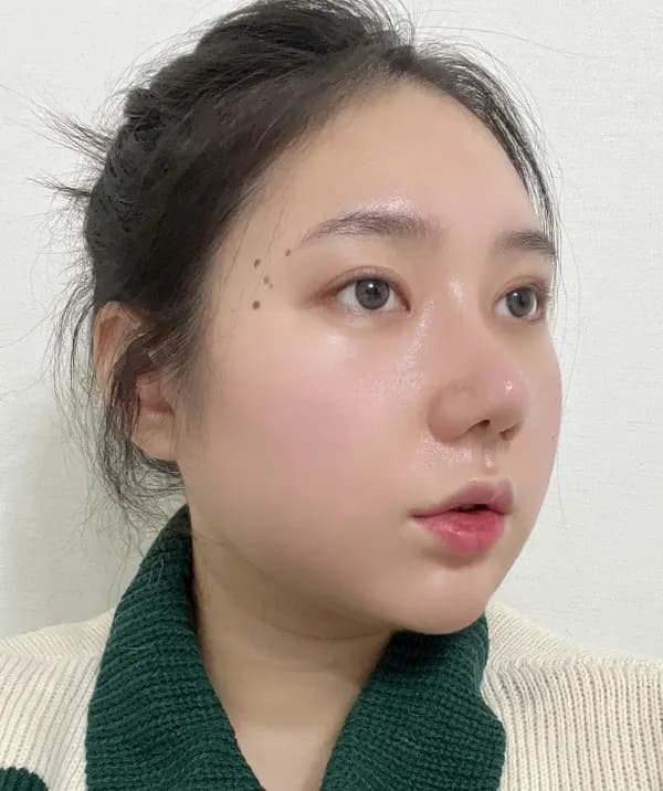手術後30日目