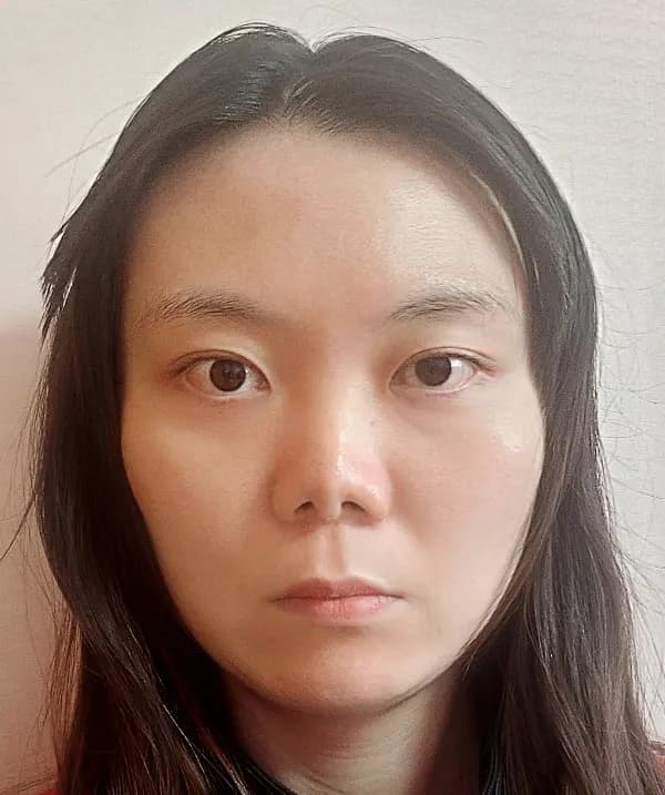 Before and after surgery front view