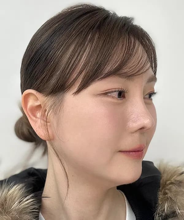 Before and after surgery side view