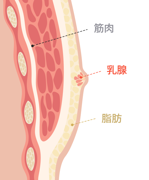 Gynecomastia surgery