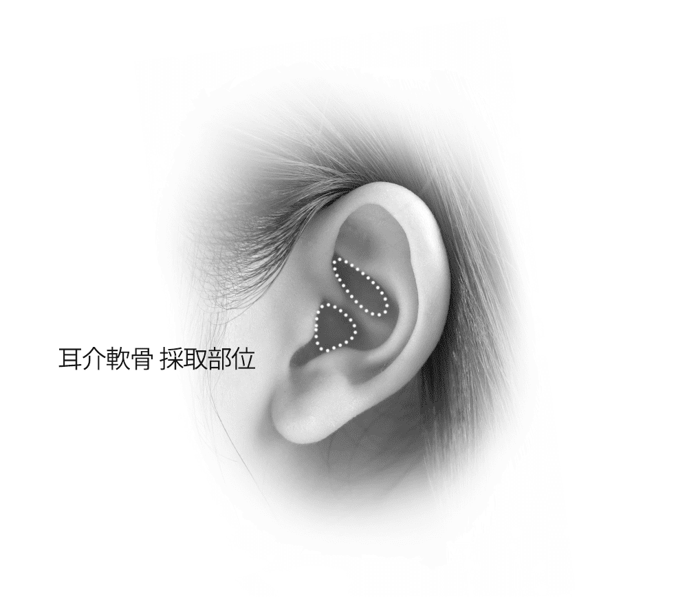 耳介軟骨の採取