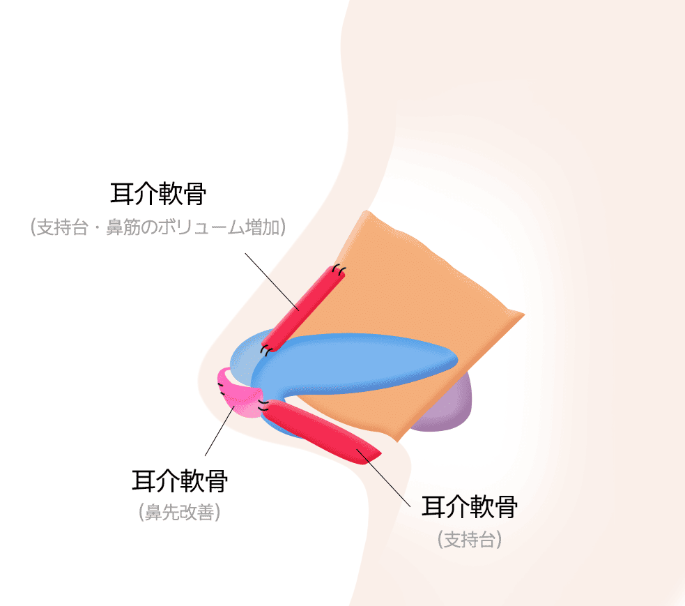 耳介軟骨による鼻筋・鼻柱・鼻先の形成