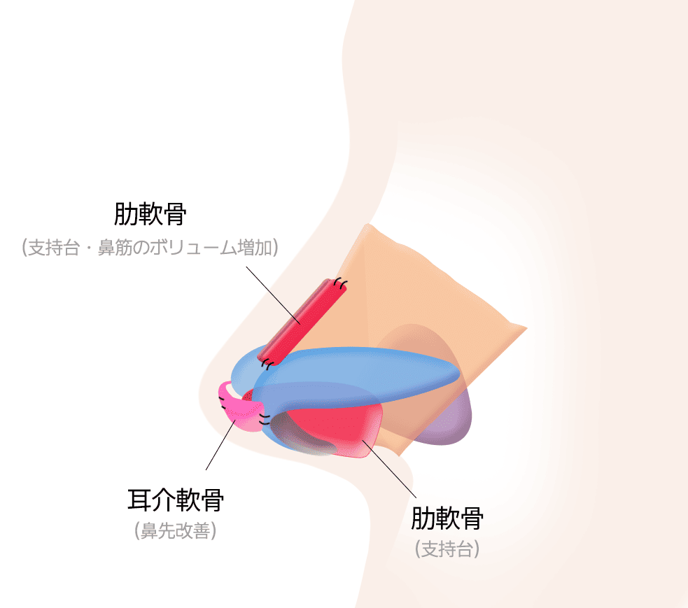 肋軟骨による形成