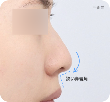 CASE 1. 狭い鼻唇角 before