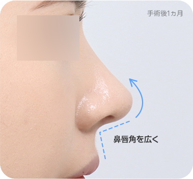 CASE 1. 狭い鼻唇角 after
