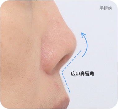 CASE 2. 広い鼻唇角 before
