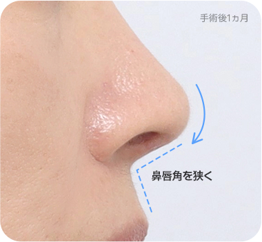 CASE 2. 広い鼻唇角 after