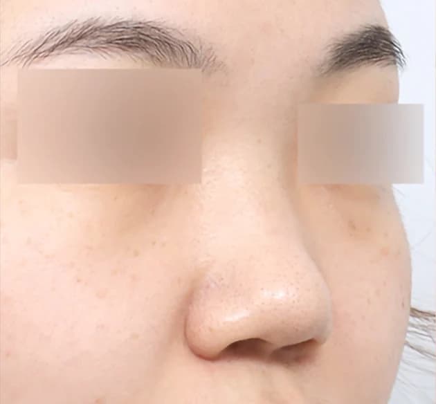 自然な鼻筋 before