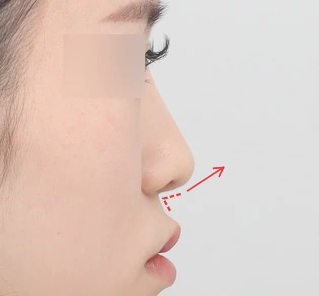 上品な立体感の鼻唇角 before