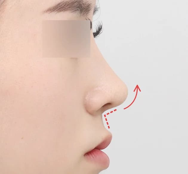 上品な立体感の鼻唇角 after