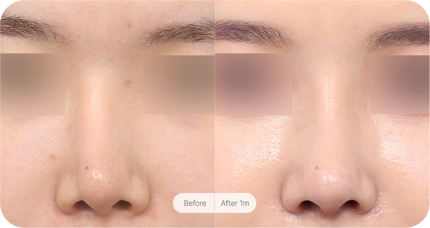 revision-rhinoplasty