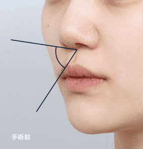 鼻柱が凹んで見える側面