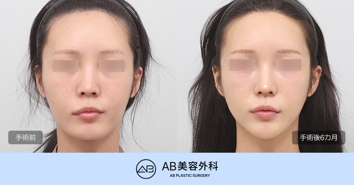 芸能人のような小顔・輪郭整形は可能？たるみなどの副作用なしで実現できるのか