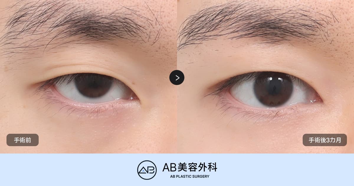 男性の目の整形｜自然で長く、すっきりした目元を作る方法