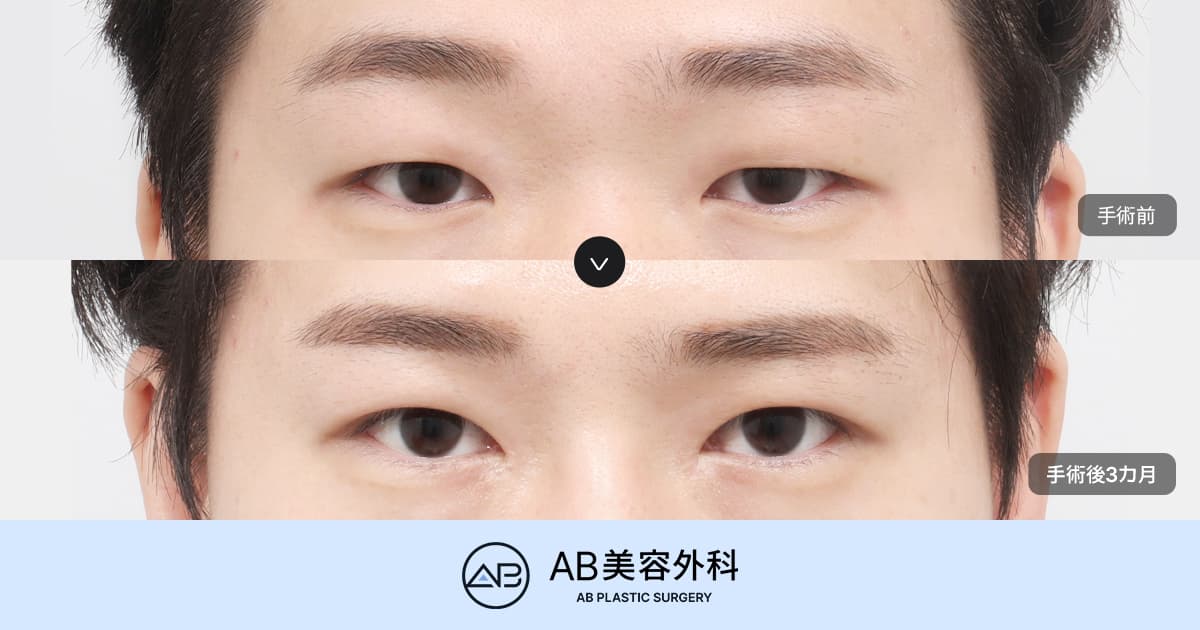男性の左右非対称矯正と自然な目元形成｜男性の眼瞼下垂・目元形成手術