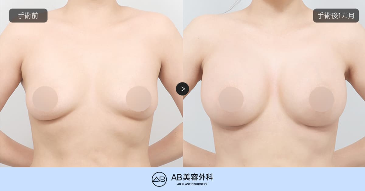 バストのたるみは程度によって治療方法が異なりますか？｜バストリフト解説
