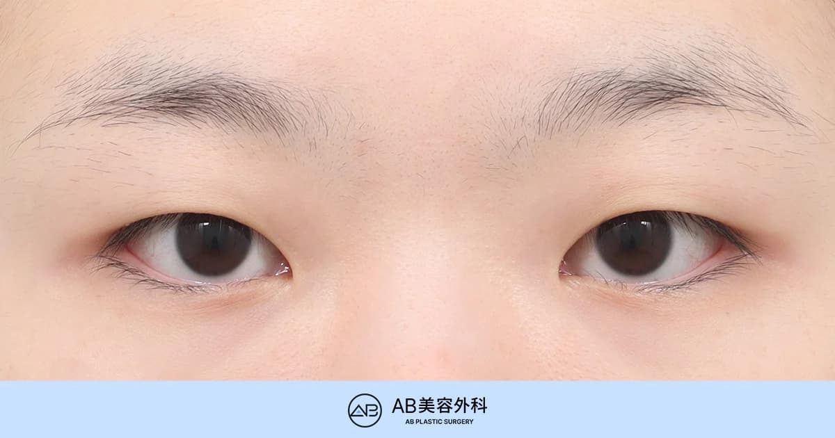 一重まぶた女性の眼瞼下垂矯正・チェックポイント