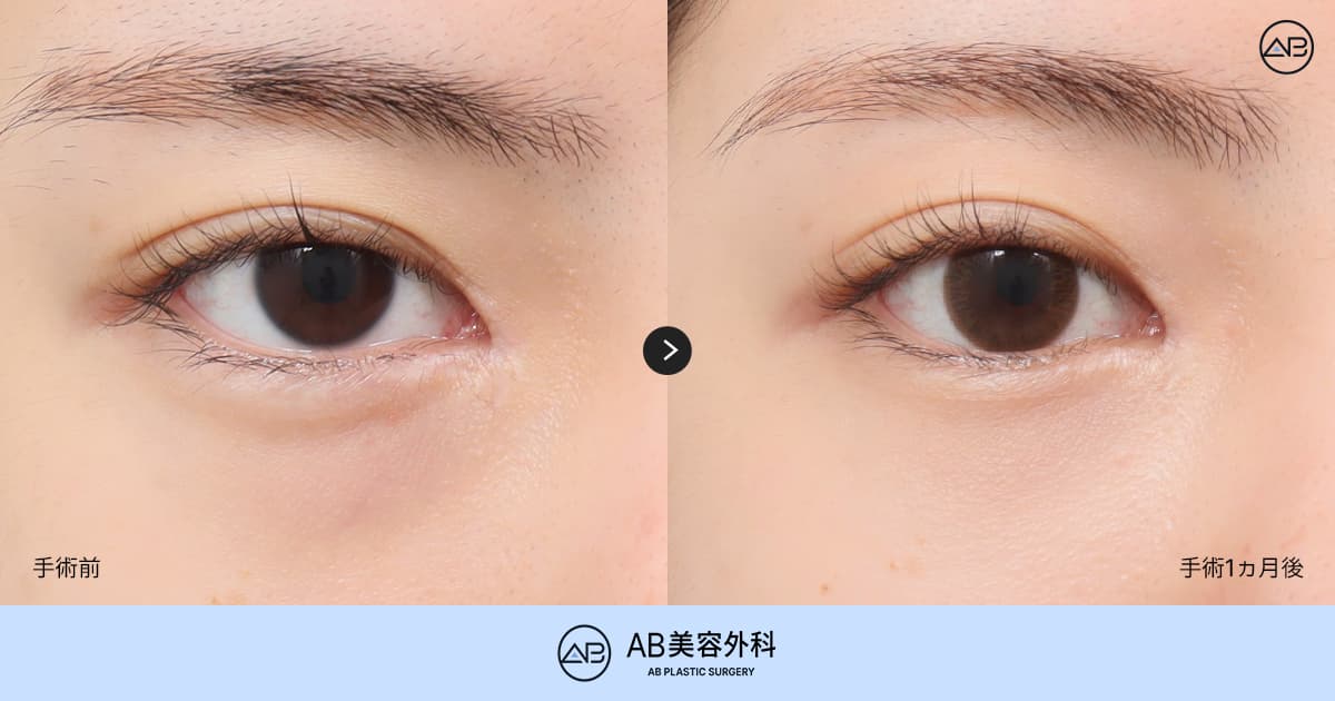 目の下の脂肪除去で後悔しないために手術前に必ず確認したい脂肪除去と再配置の違い