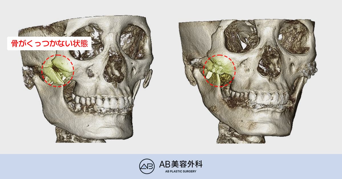 頬骨縮小術後に骨が開いた？「頬骨骨癒合不全（非癒合）」の誤解と本当の原因