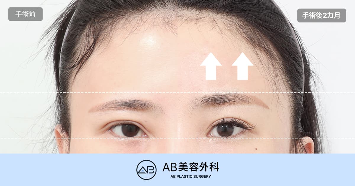 内視鏡額リフト｜ボーントンネリング法とエンドタイン法の違い・術前術後の変化と効果を比較