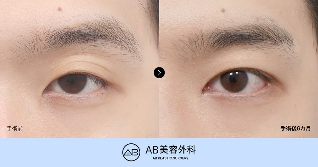 眠たそうな男性の目元を自然で爽やかな印象へ｜男性目整形の症例とデザインポイント