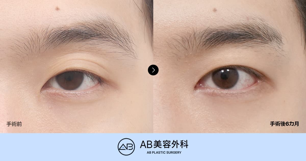 眠たそうな男性の目元を自然で爽やかな印象へ｜男性目整形の症例とデザインポイント
