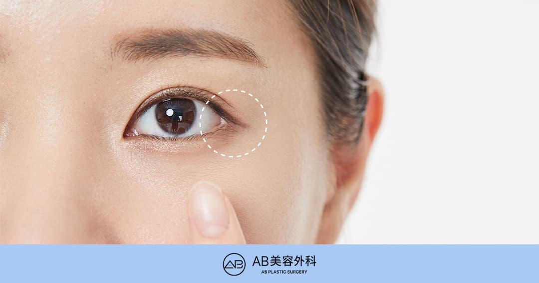 目尻切開の副作用は必ず起こる？おすすめ・おすすめしにくいタイプを解説