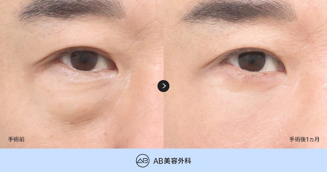 老けて見える目の下を改善する中年の目元整形｜下眼瞼手術だけが答え？目の下の脂肪再配置との違い