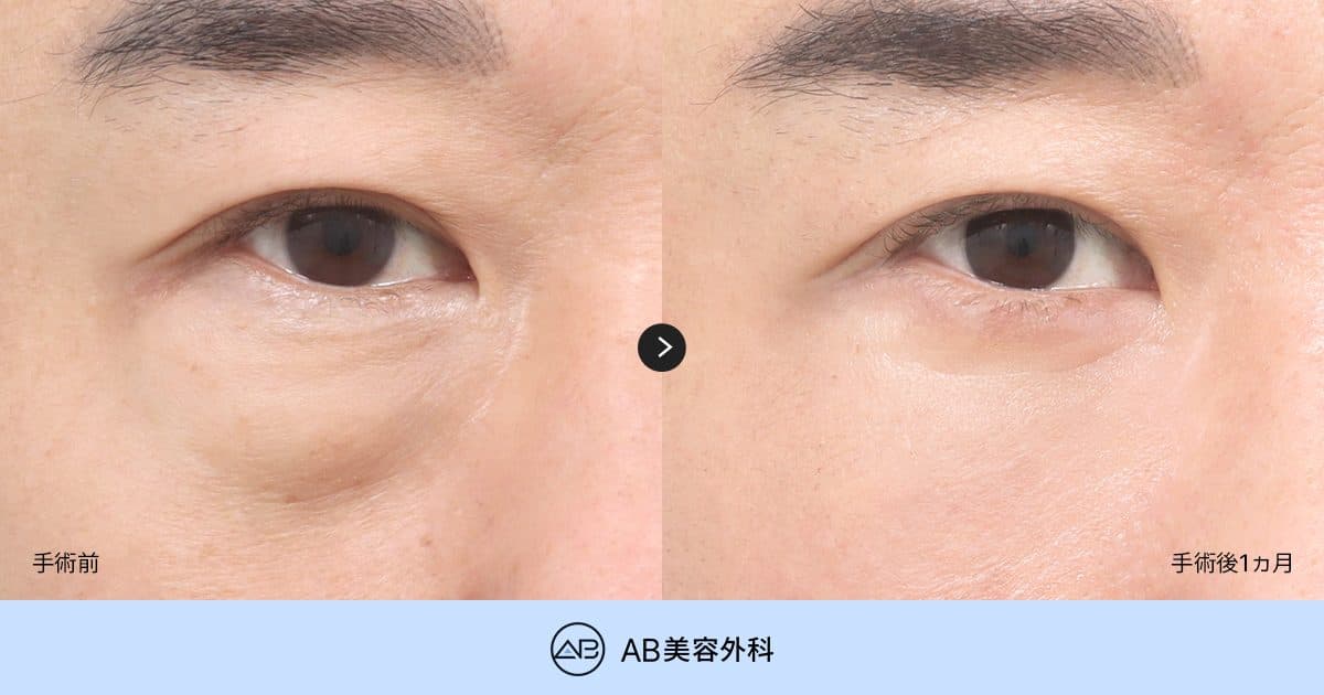 老けて見える目の下を改善する中年の目元整形｜下眼瞼手術だけが答え？目の下の脂肪再配置との違い