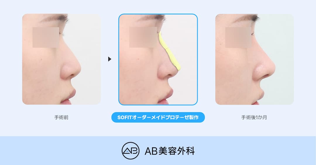SOFIT（ソフィット）鼻整形とは？一般的なプロテーゼとの違いとオーダーメイドプロテーゼが適しているケース