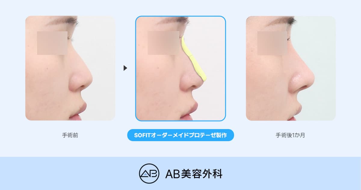 SOFIT（ソフィット）鼻整形とは？一般的なプロテーゼとの違いとオーダーメイドプロテーゼが適しているケース