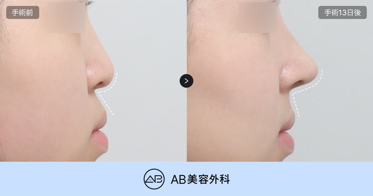 鼻先整形の完成度を左右する「鼻柱ライン」と「鼻唇角」