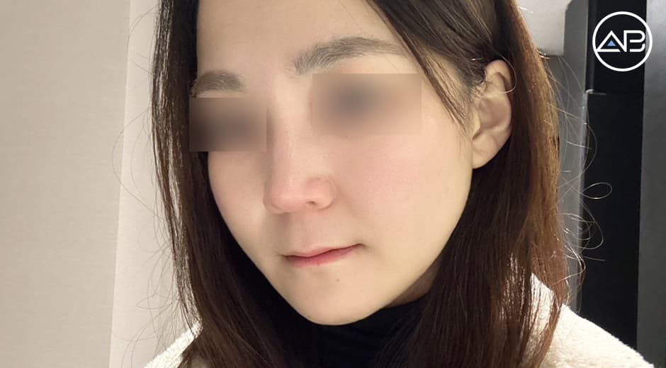 輪郭3点手術から1ヶ月が経過しました。